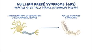 क्या है Guillain-Barre Syndrome? जिसकी वजह से पेरू में लगाई गई है हेल्थ इमरजेंसी |_3.1